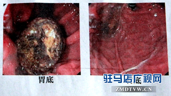 ↑取石前 取石后↑.jpg