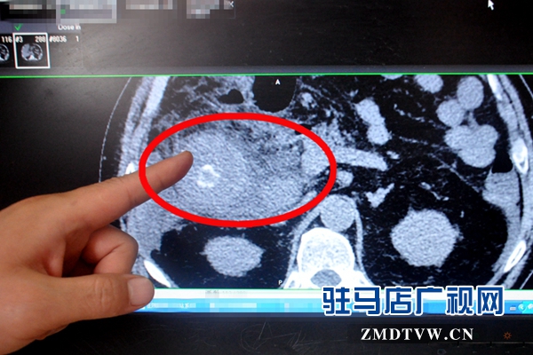 CT下顯示巨大的膽囊(長約15cm 最大直徑10cm).JPG