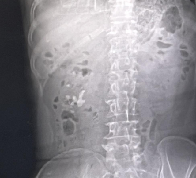 12歲少年患腎結石敲警鐘!科學飲食調理成防石關鍵