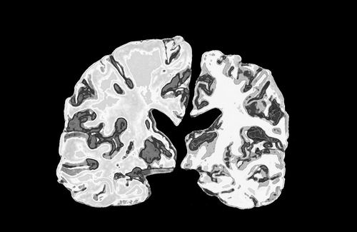 補充鋰元素可能逆轉阿爾茨海默病