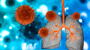 中招這種病菌小心肺部“發(fā)霉” 這幾類人群尤其要注意