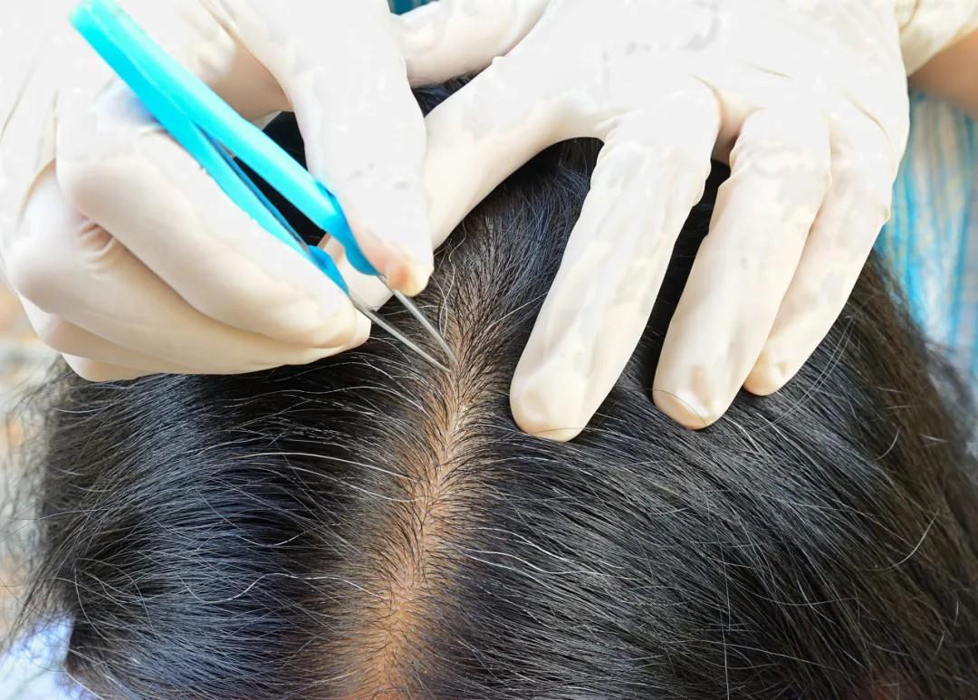 白頭發拔一根長三根？到底能不能拔？終于弄清楚了