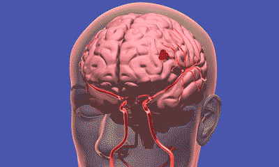 腦梗高發季到了！有3種不舒服，千萬別大意