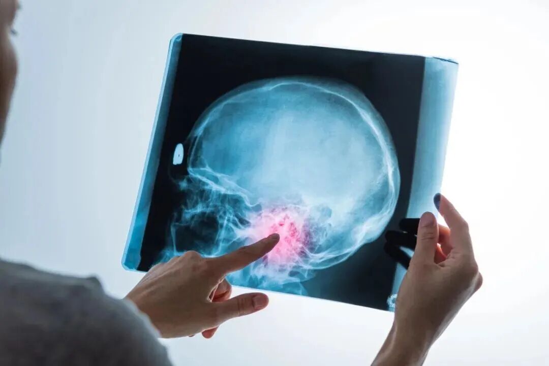 腦梗高發季到了！有3種不舒服，千萬別大意