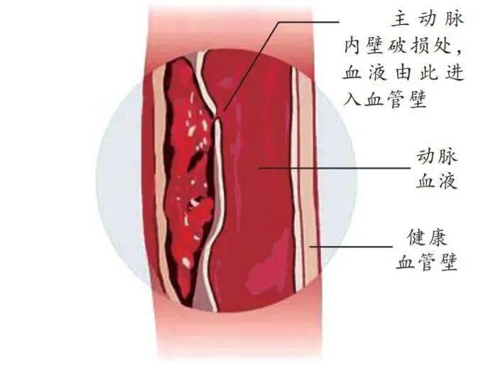 防寒更要防病！醫生提醒：別讓低溫“凍”破主動脈