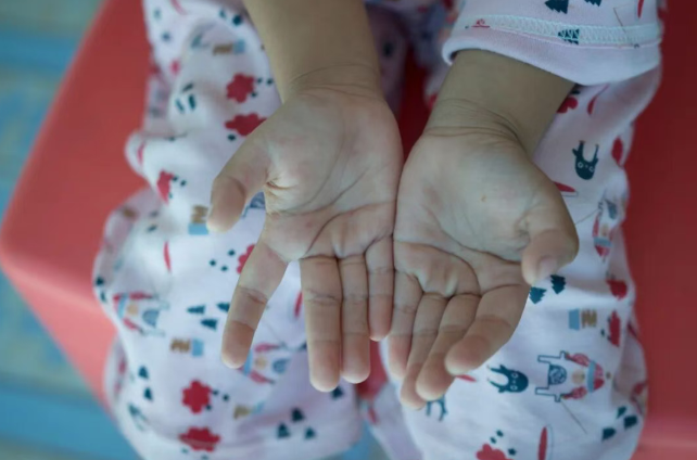 關于手足口病的8個常見誤區，一次說清！