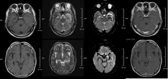 30歲小伙長期熬夜智力退回3歲 年輕人患“腦膜炎”病例為何頻發?