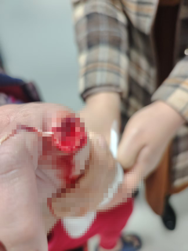 自家寵物犬突然發狂咬斷主人手指 專家提醒犬傷處置切勿拖延